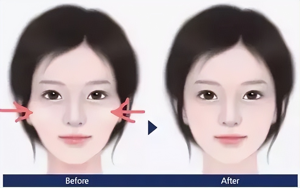 颧骨外扩怎么科学改善,怎么判断是颧骨突出还是颧弓外扩