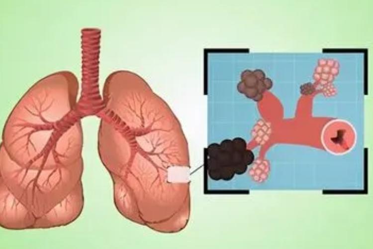 畏寒发热咳浓痰治疗方法,畏寒黄痰咳嗽