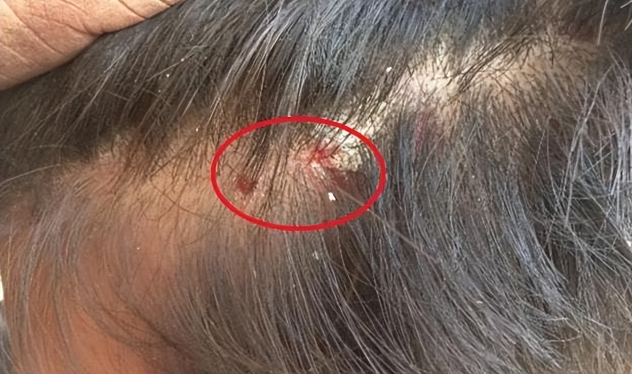 头上起疙瘩有脓包还掉发什么原因,老人头上总是起脓包疙瘩