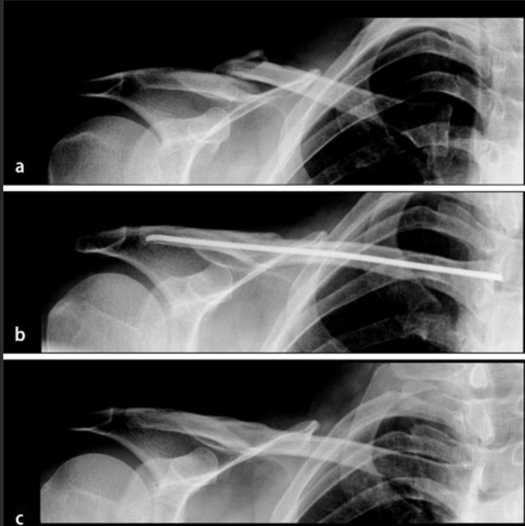 锁骨骨折吃什么食物最好,锁骨骨折怎么绑绷带视频