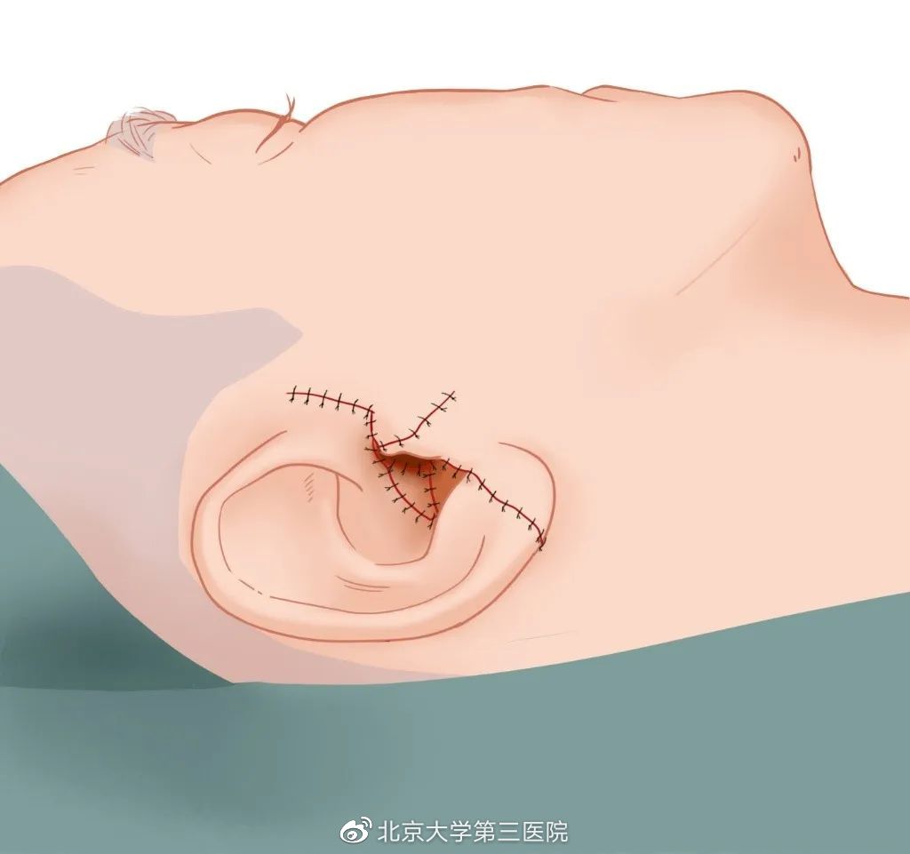 意外留疤怎么安慰,眉尾意外受伤留疤好不好
