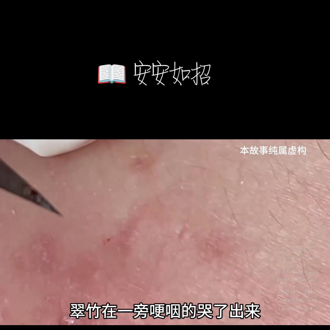 📖安安如招后续知乎#粉刺针的正确使用方法