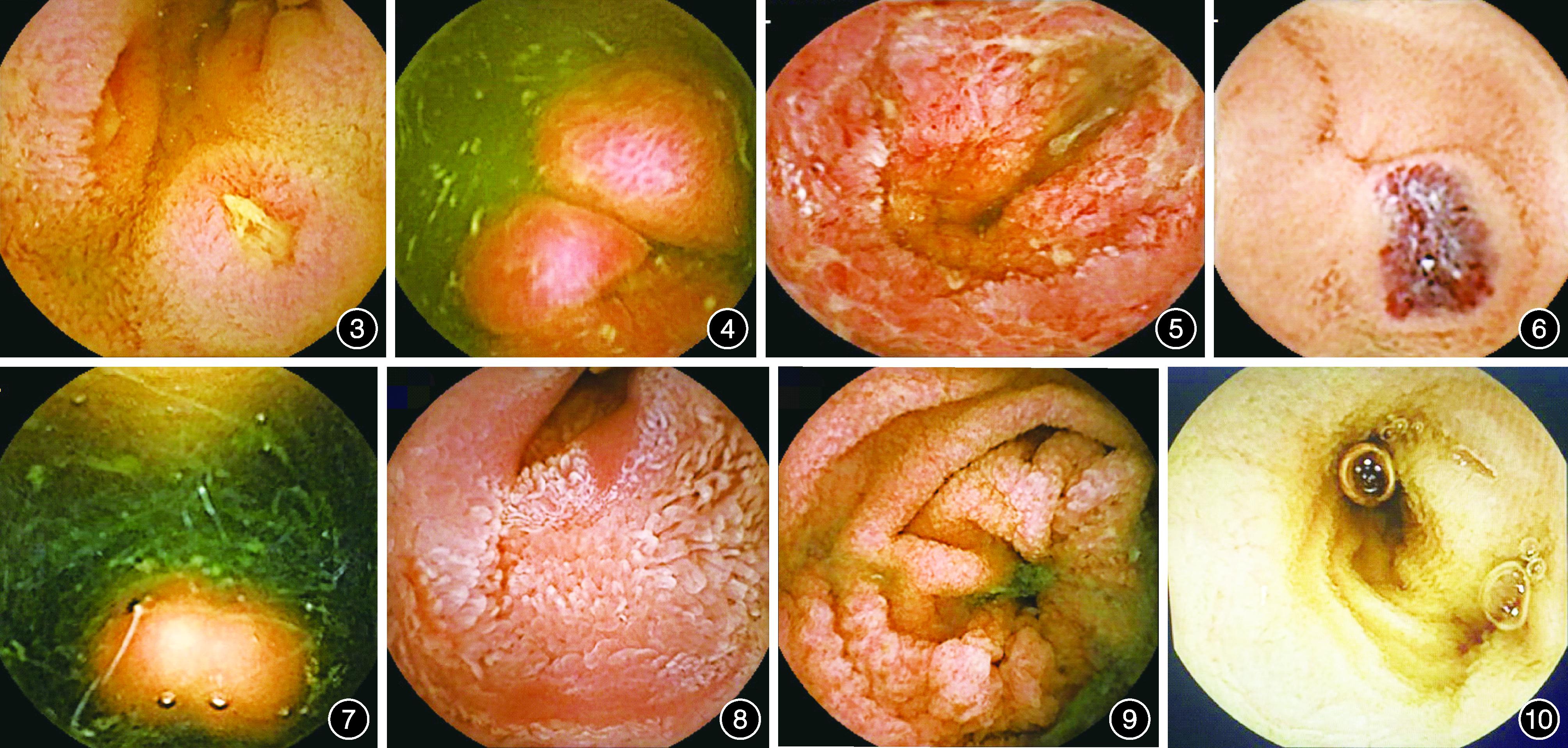 小肠造影和胶囊内镜哪个效果好,小肠胶囊内镜有必要做吗