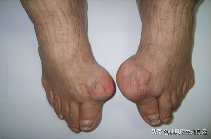 急性痛风吃秋水仙碱配什么,痛风吃秋水仙碱和非布司他的方法