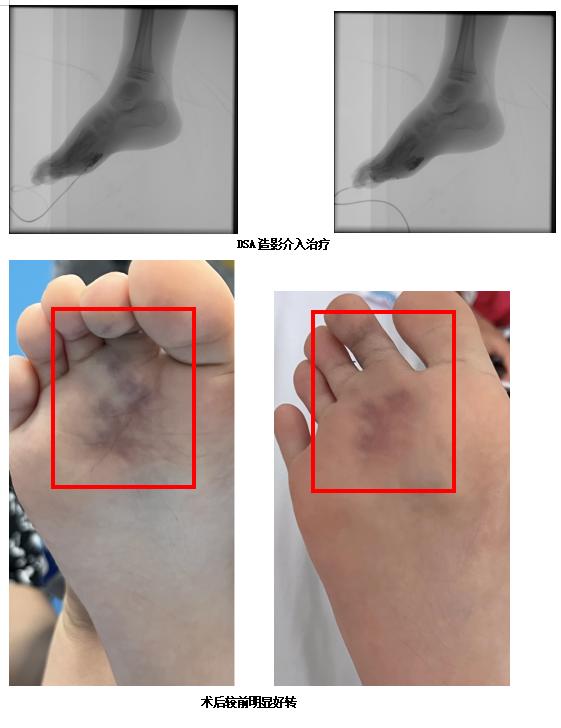 疣状静脉畸形介入治疗,下肢静脉畸形介入手术全过程