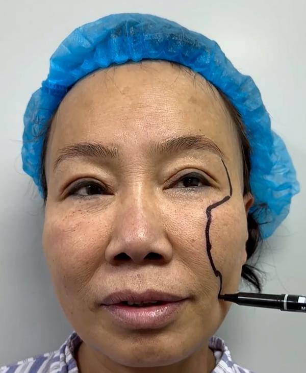 大拉皮手术34岁适合做吗,56岁面部拉皮术后效果