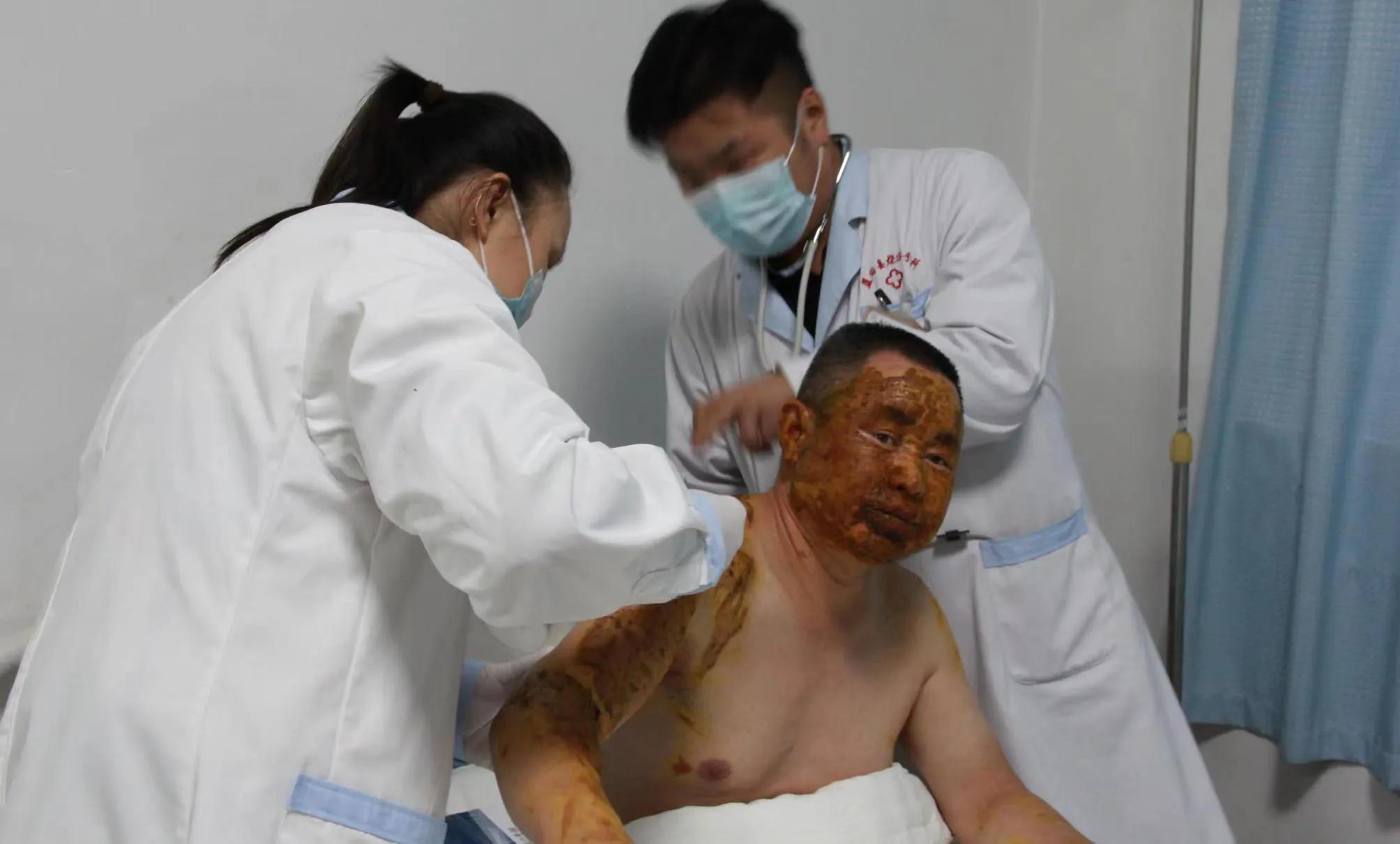 中医药烧伤治疗学,专业治疗烧伤的医生