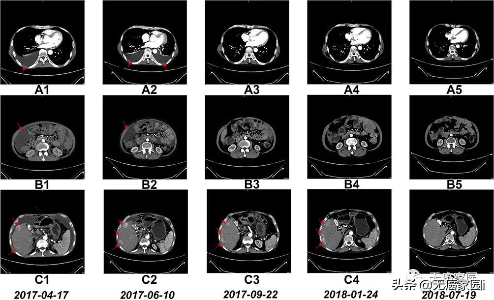肝癌的防治干预计划,肝癌患者免疫治疗需长期治疗吗