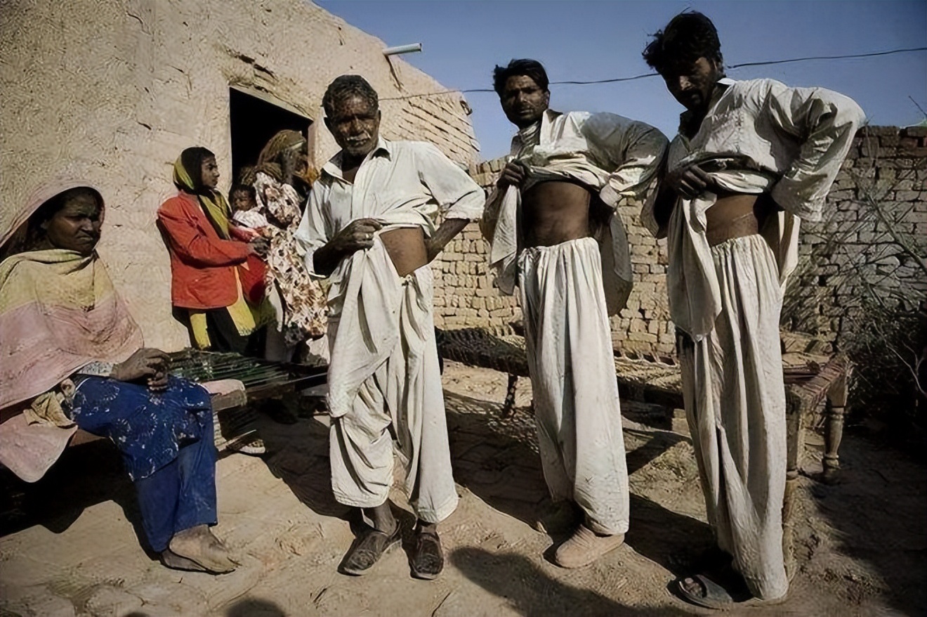 尼泊尔单肾村的故事,尼泊尔单肾村