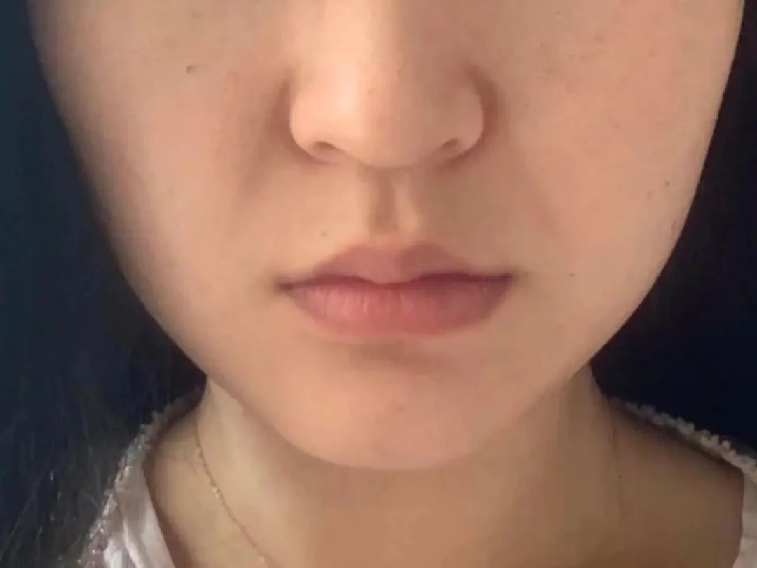 很深的法令纹怎么消除,已经有很深的法令纹怎么消除