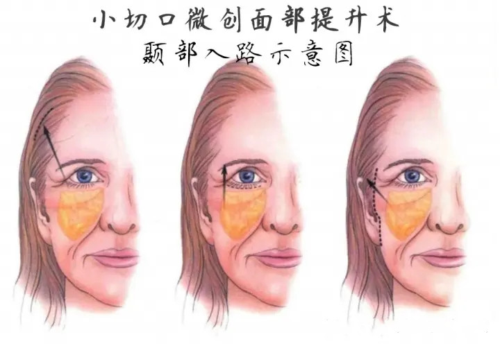 法令纹最好有效的去除方法,有法令纹最好的解决办法真实有效