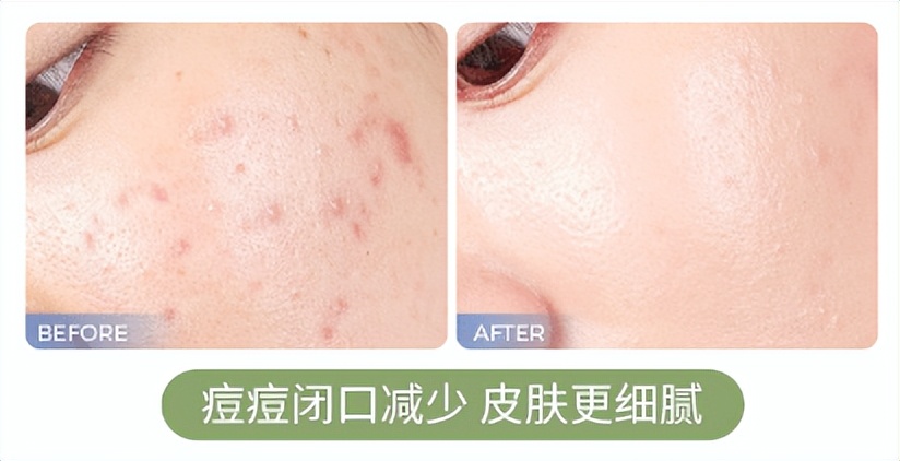 什么面膜清洁毛孔黑头效果好,清洁面膜有用吗真的能清洁毛孔吗