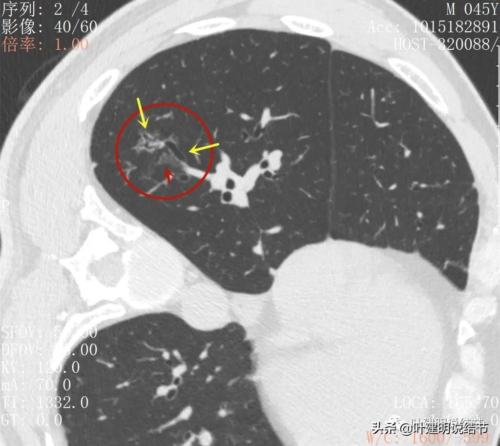 误诊肺纤维化,肺蜂窝状是癌吗
