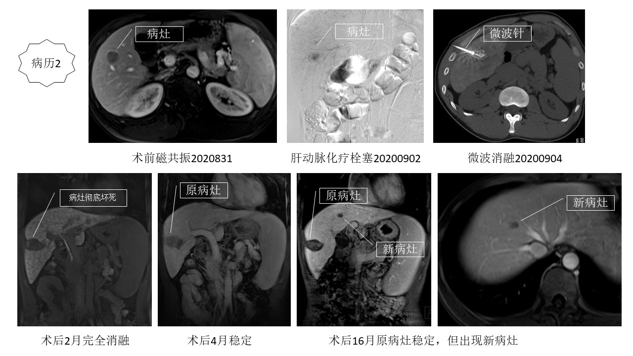 肿瘤局部消融的病历举例