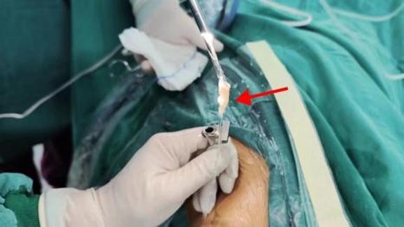 “镜”显其能—北京大学第三医院派驻秦皇岛专家成功救治急性足下垂患者