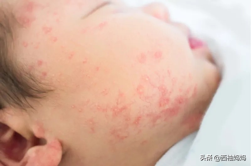 有湿疹的宝宝过敏是什么样的,宝宝过敏引起的湿疹需要去医院吗