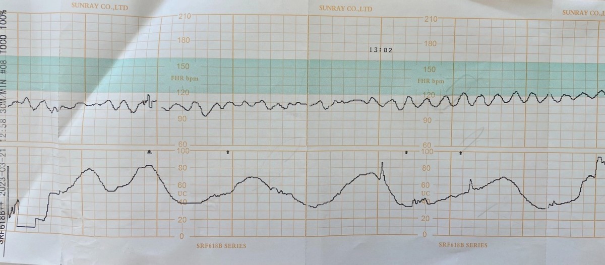 孕34周突然大出血，苏州九龙医院医生争分夺秒守护母子平安