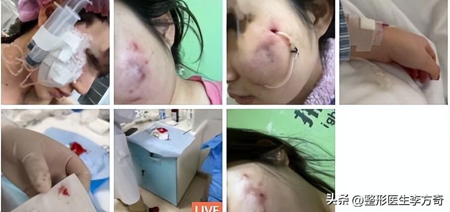 为变美打美容针真的值得吗,脸部变美可以注射几种美容针