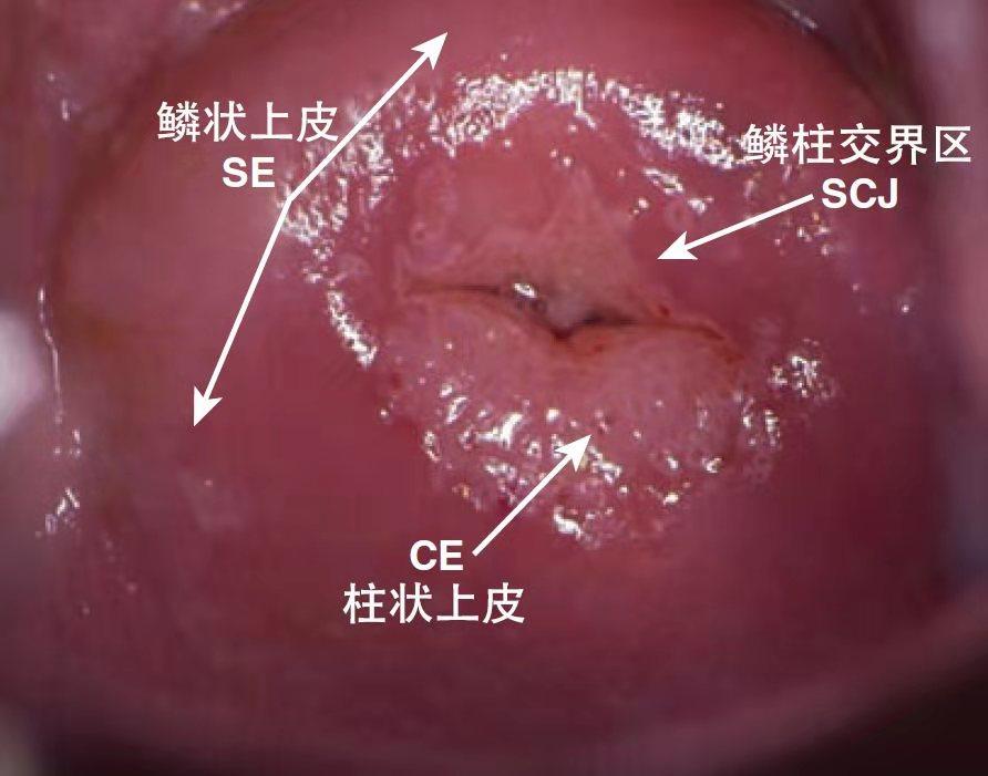 派特灵派特生物科普｜冷刀宫颈锥切术操作步骤和注意事项