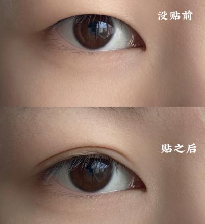 肿眼皮双眼皮贴正确的贴法,双眼皮贴干货