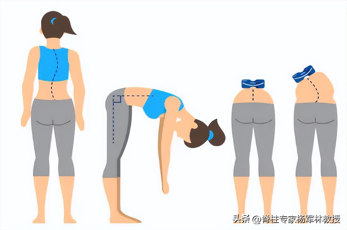 脊柱侧弯10度会出现剃刀背吗,剃刀背会误诊吗