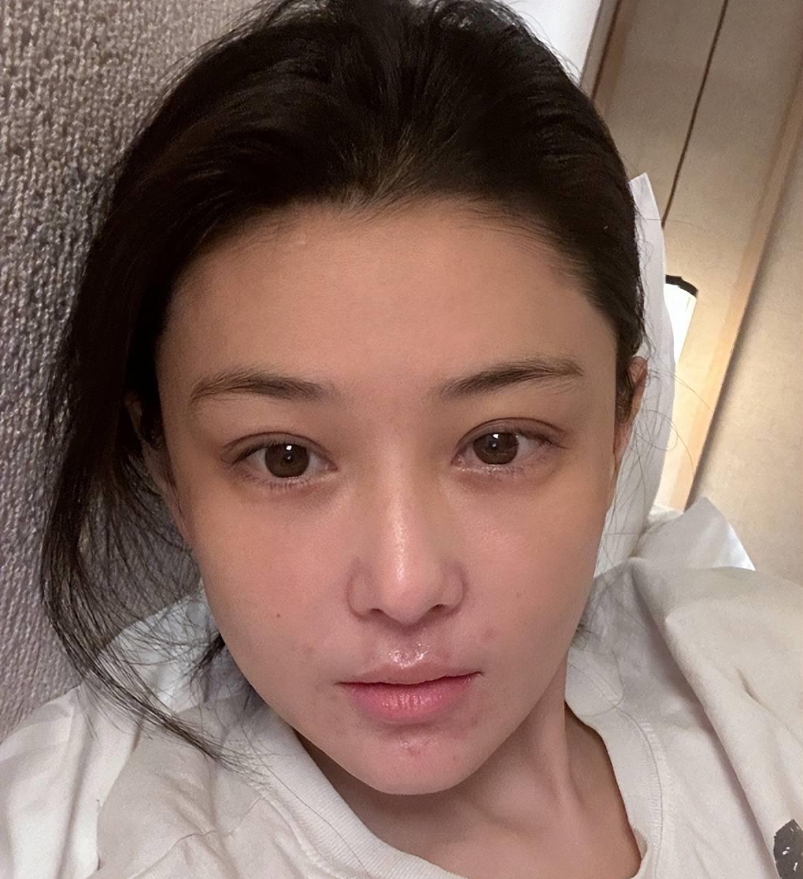 张馨予过敏皮炎第几期,张馨予皮肤过敏涂的什么