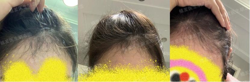 植发后后枕部的头发多久能恢复,植发手术后3个月恢复过程