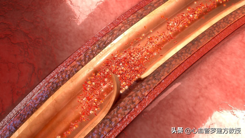 主动脉夹层动脉瘤什么原因造成的,主动脉夹层动脉瘤是什么症状