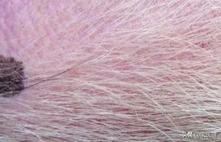 小孩鱼刺卡喉能自愈吗,鱼刺卡喉半年寻医无果