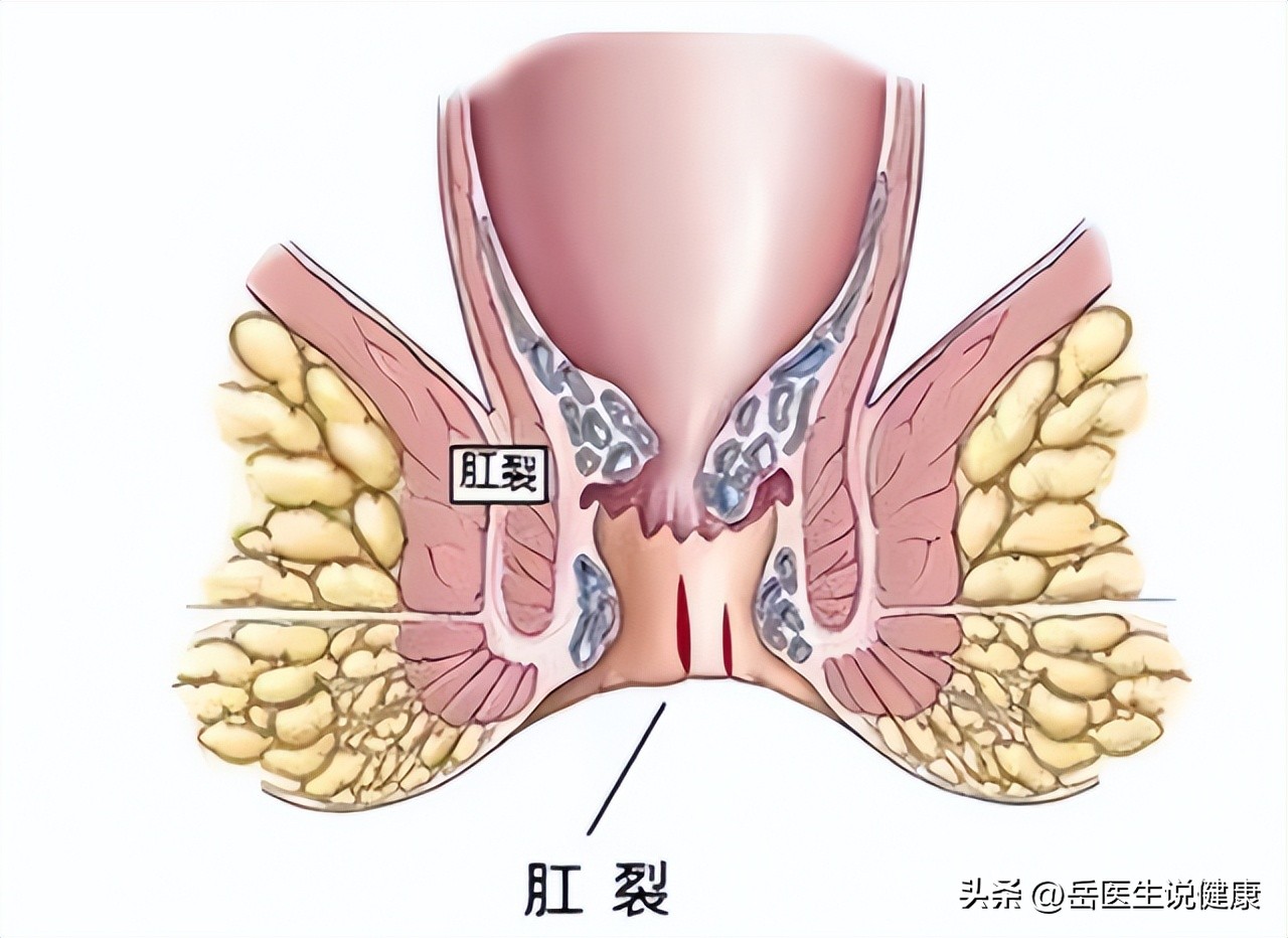 为什么女性比较容易肛裂,为什么越来越多的女性肛裂