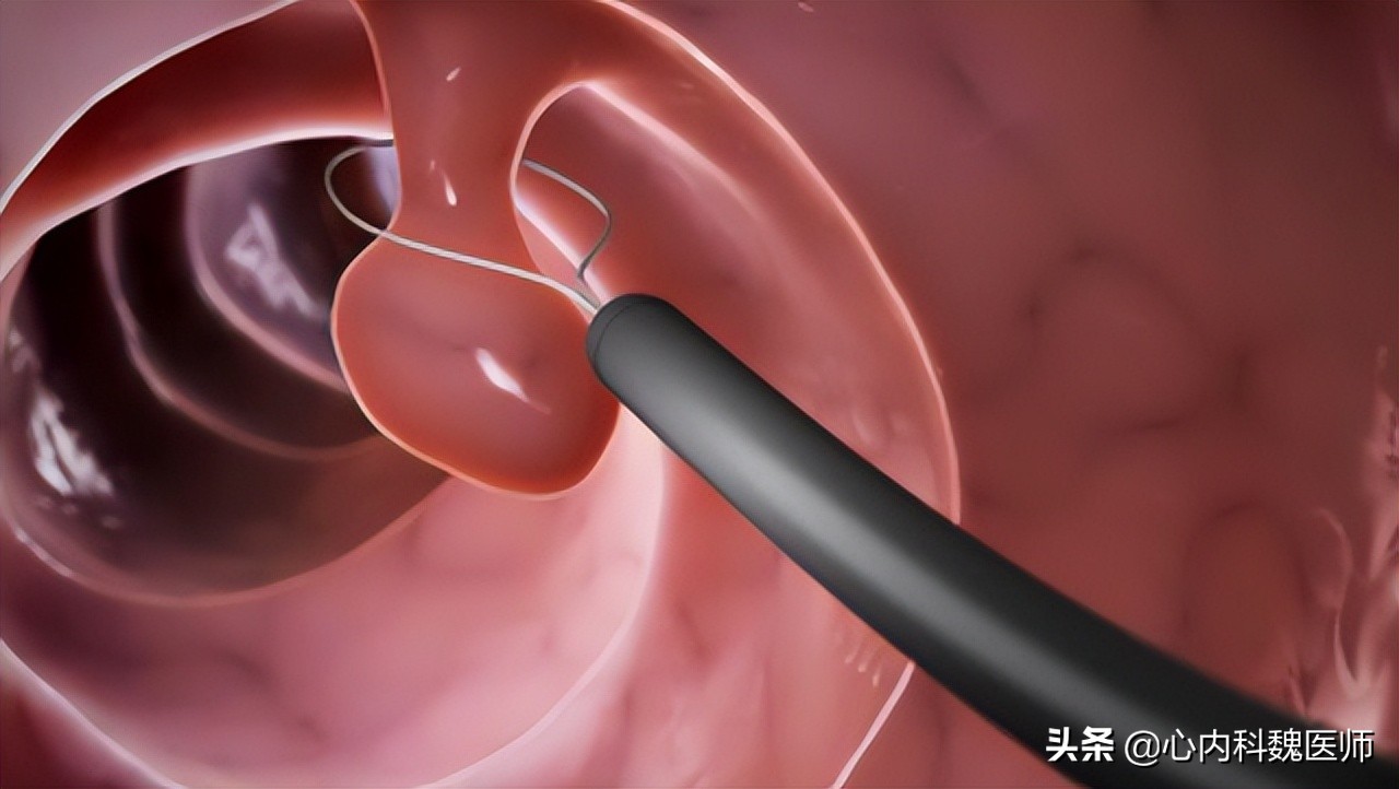 肠息肉切除后一般多久要复查,肠息肉切除后复查正常多久再复查