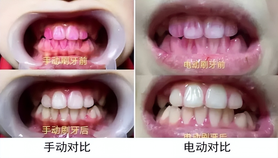 飞利浦usmile电动牙刷测评,电动牙刷推荐欧乐b