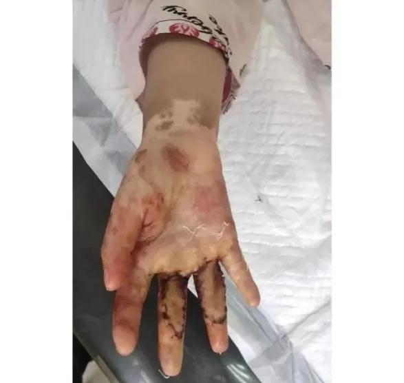 恶毒母亲开水烫伤5岁女孩,甘肃4岁女童被继母虐待事件后续