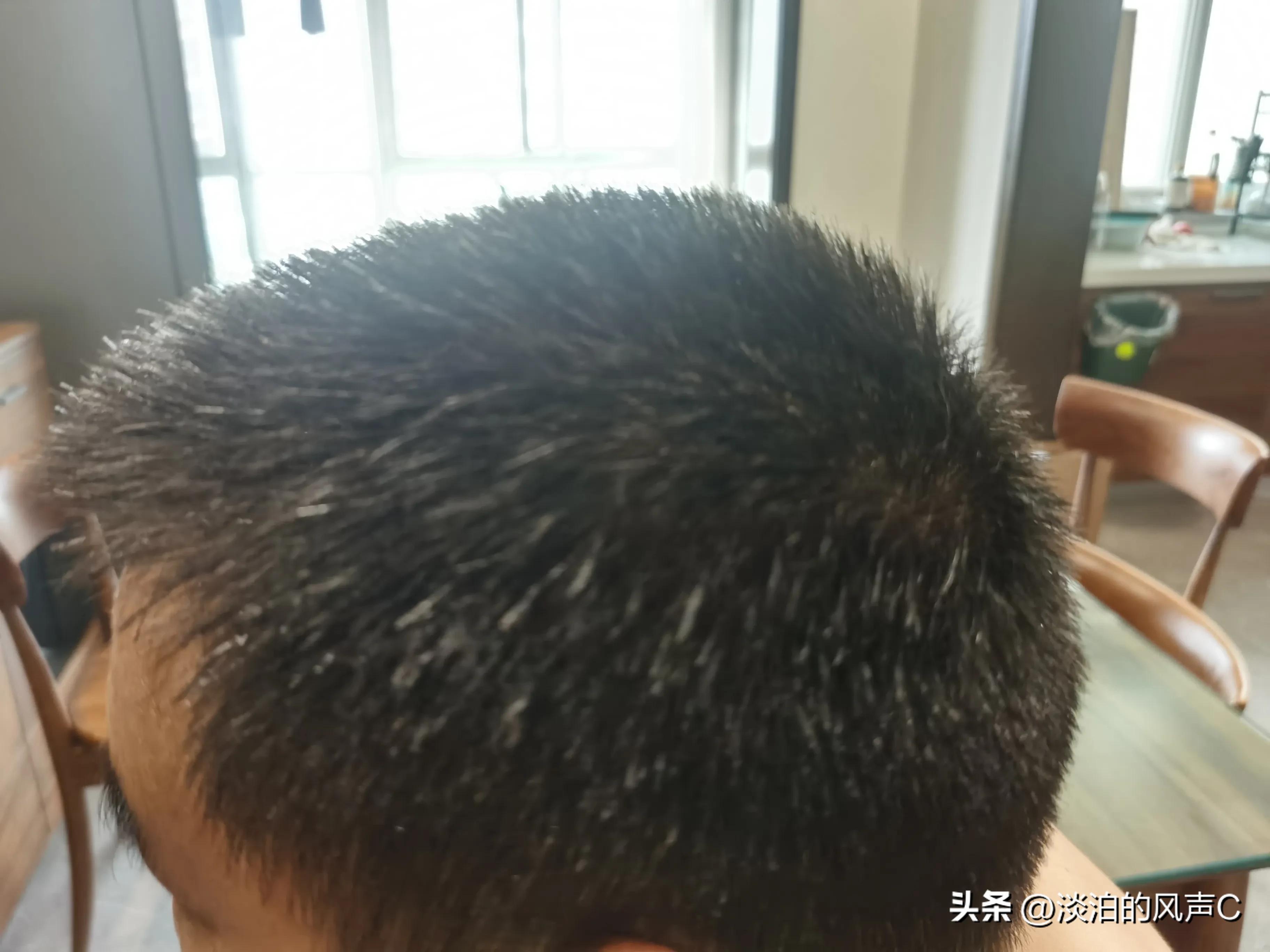 白发掉发头皮屑多吃什么改善,解决白发掉发头皮屑一切问题