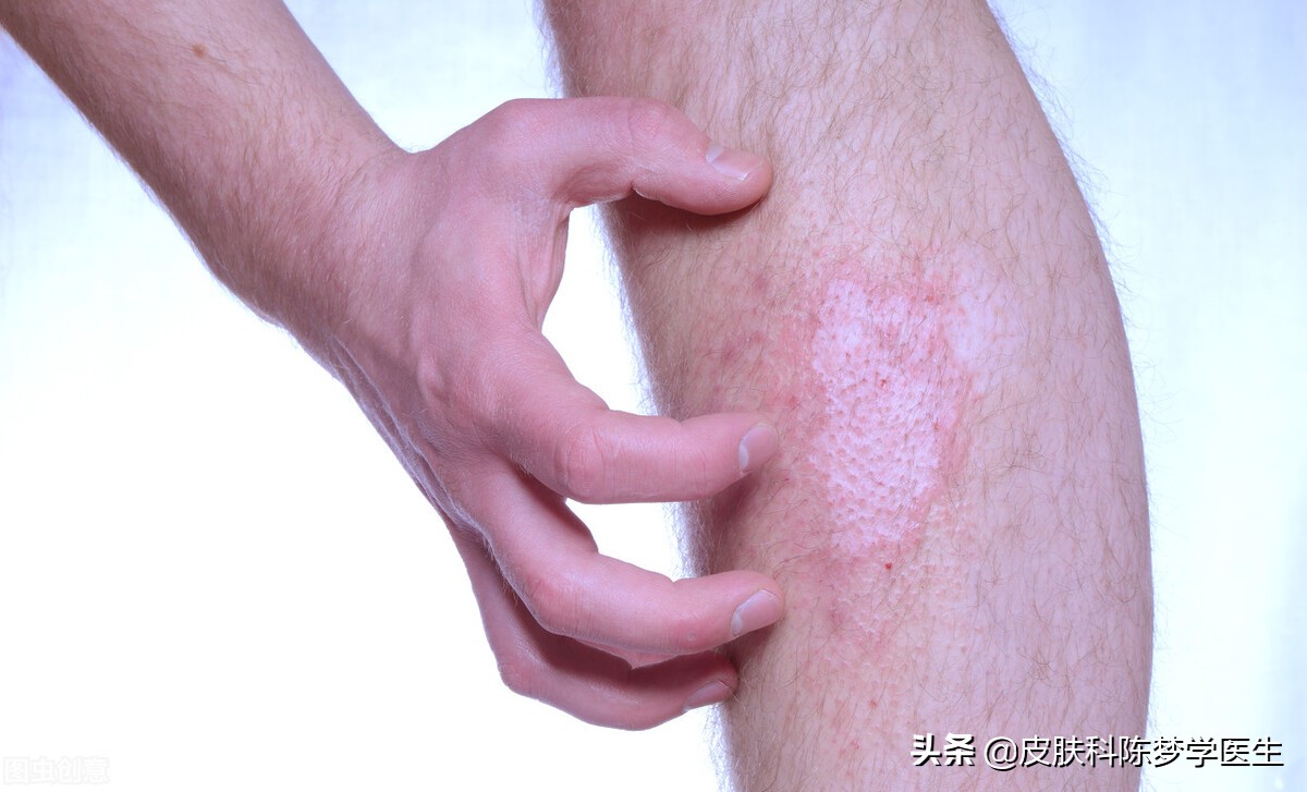 脸上出红斑一定是红斑狼疮吗,脸上长鳞屑红斑性皮疹