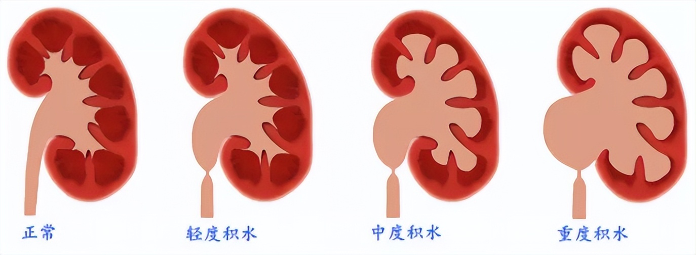 输尿管结石有什么明显的症状,输尿管结石主要症状问答库
