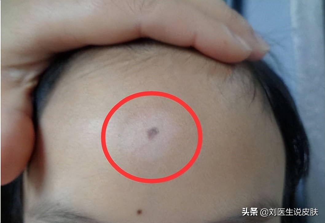 晕痣型白癜风初期和中期的区别,早期晕痣型白癜风怎么治疗