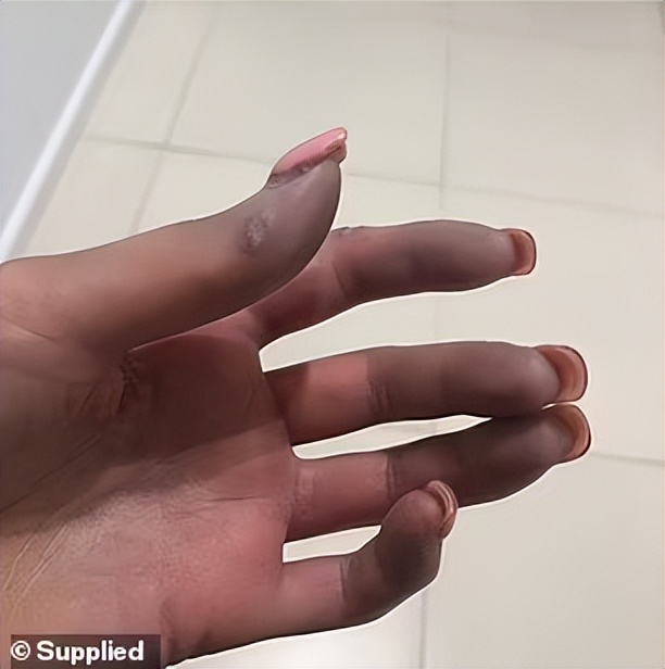 澳洲女子病体产生胶原蛋白,澳洲女子患绝症