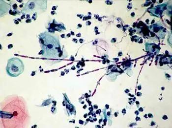 皮肤念珠菌病是什么症状,皮肤念珠菌病传染吗