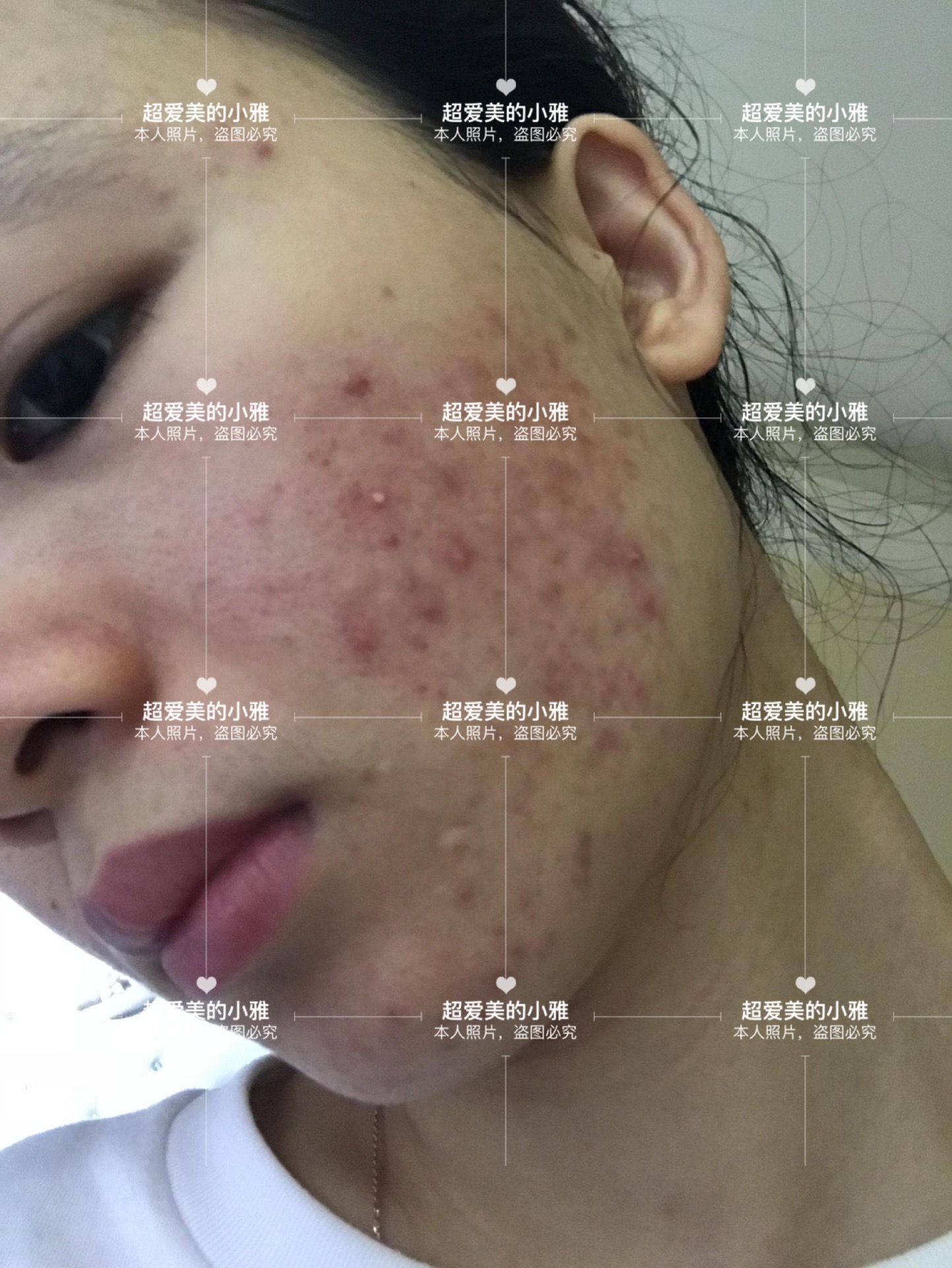 痘痘严重爆发如何战痘到底,痘痘的常见问题解决方法在这里