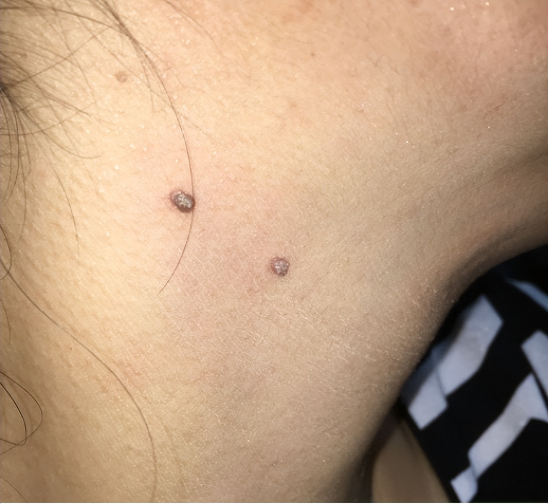 脖子上有丝状疣和皮赘怎么办,丝状疣和丝状皮赘怎么区别