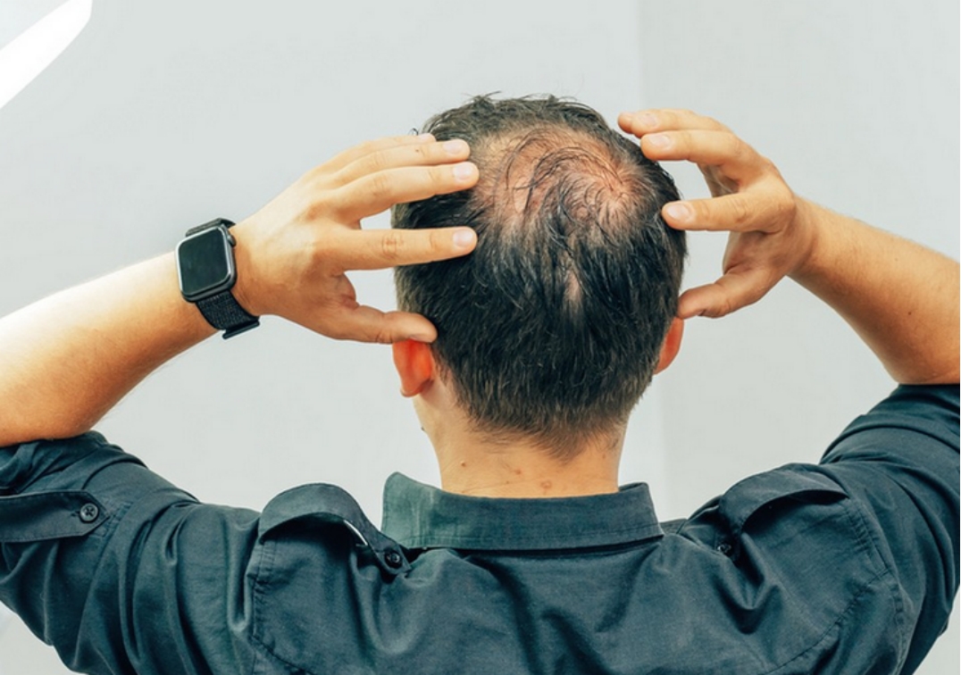 怎么脱发最有效果,怎么样脱发才算严重