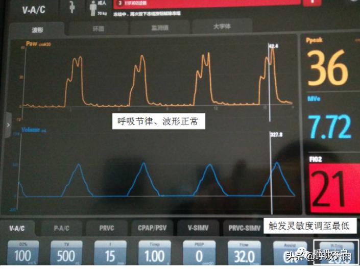 呼吸机：报警设置、心脏按压时的呼吸机设置