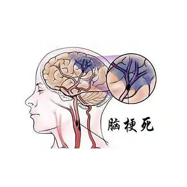 脑梗有哪些征兆和症状,无任何征兆脑梗