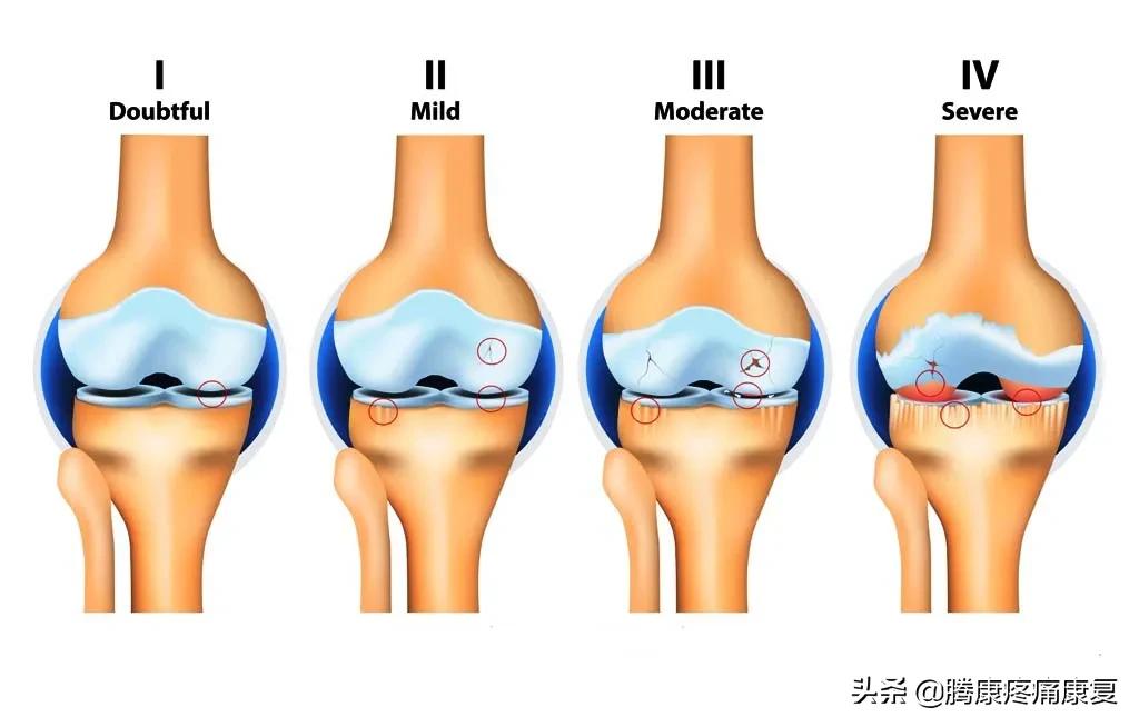 消除膝关节疼痛的方法,怎样消除膝关节响声