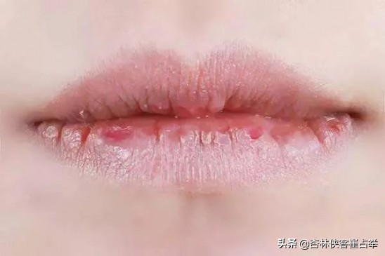 心火肝火胃火旺盛的表现症状,肝火胃火旺怎么从舌头上看出来