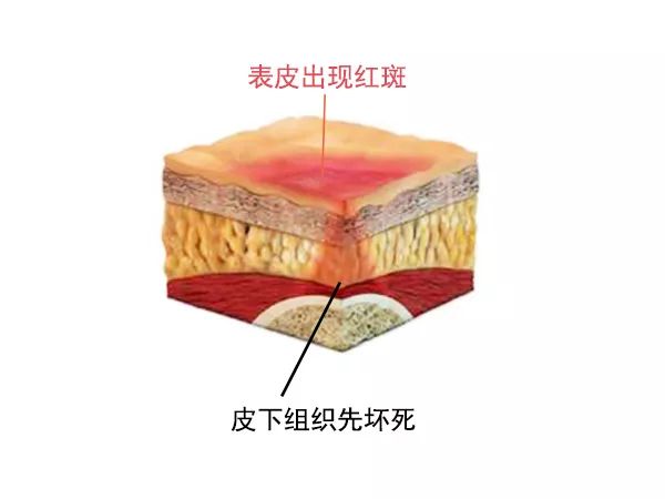 褥疮的早期症状,褥疮最早期是什么症状