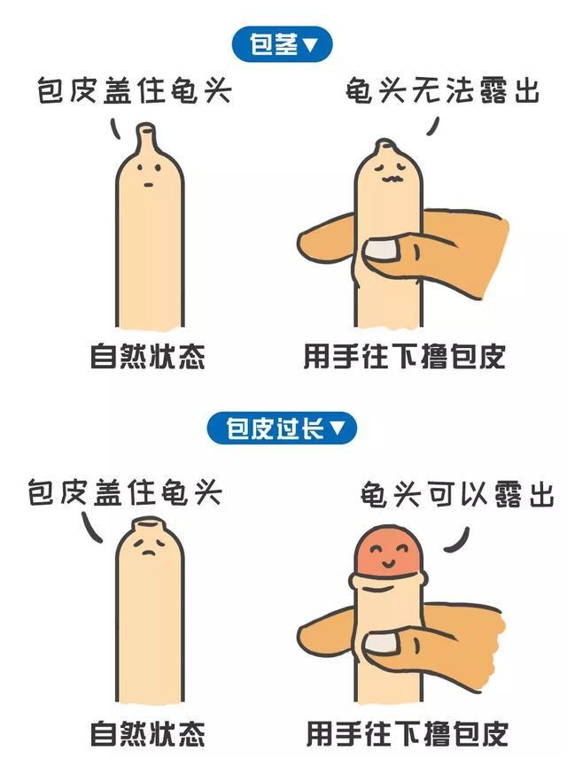 成年人包皮过长可以做手术吗,包茎包皮过长坚决不手术该咋办