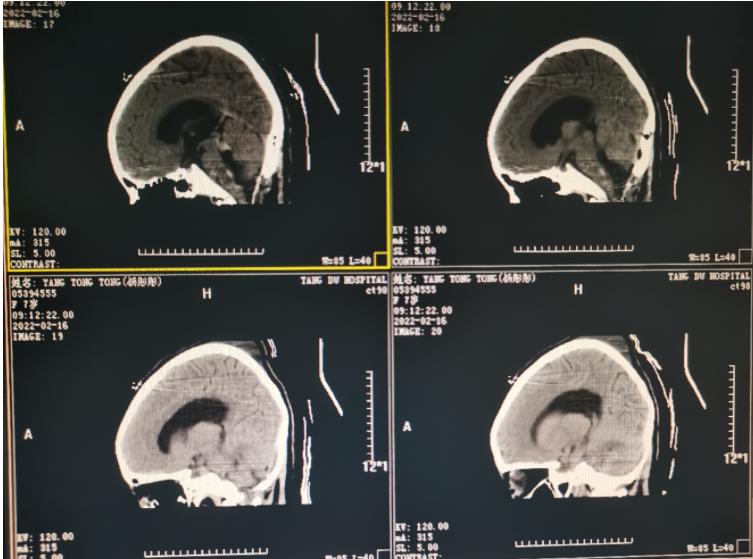 第四脑室室管膜瘤手术怎么做,第三脑室管膜瘤治疗方法
