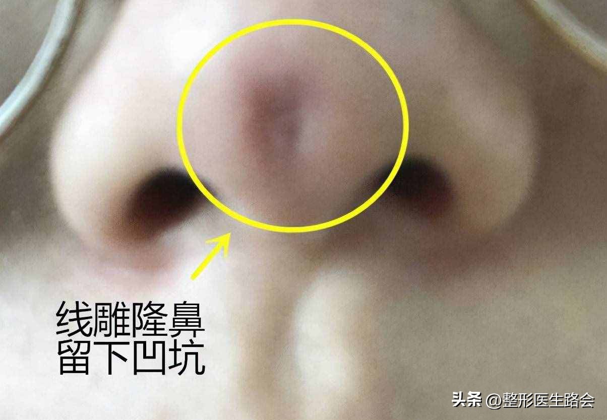 线雕鼻修复成超肋隆鼻,线雕隆鼻能解决鼻基底凹陷吗